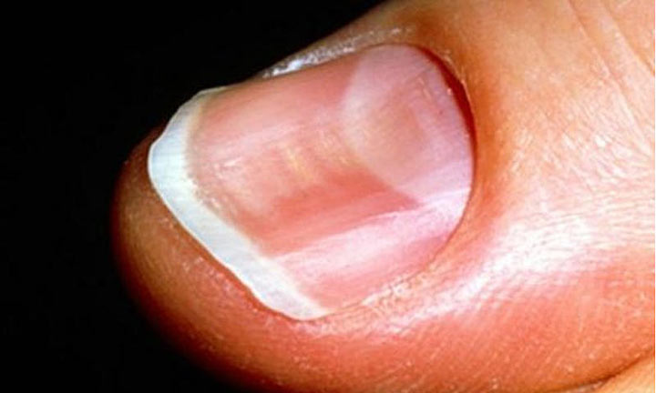 Грибок ногтя и коже.лечение и фото. грибок на пальце гомеопа.
